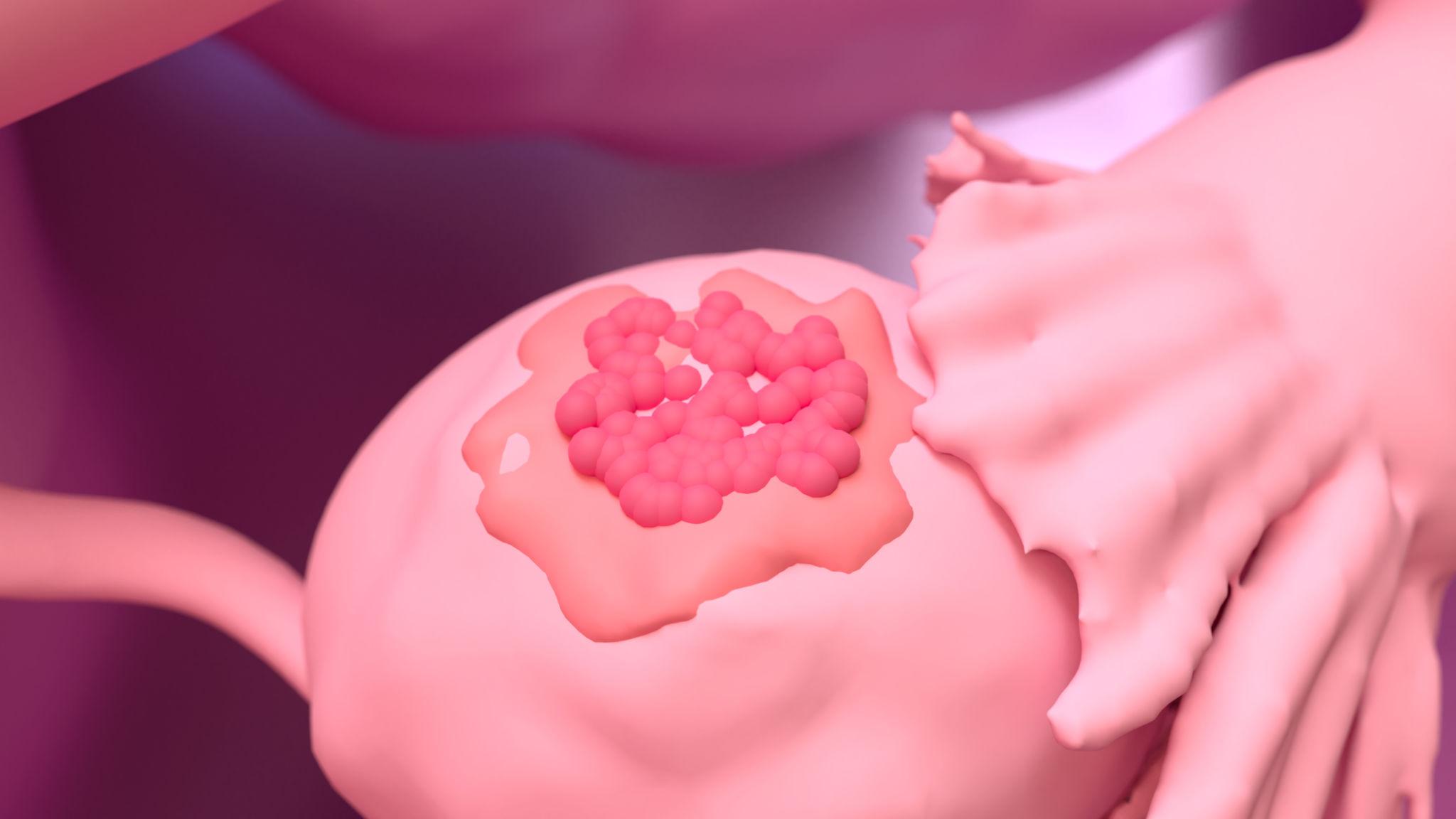 Ovarian Chocolate Cyst Treatment in Pune – Advanced Endometriosis Care